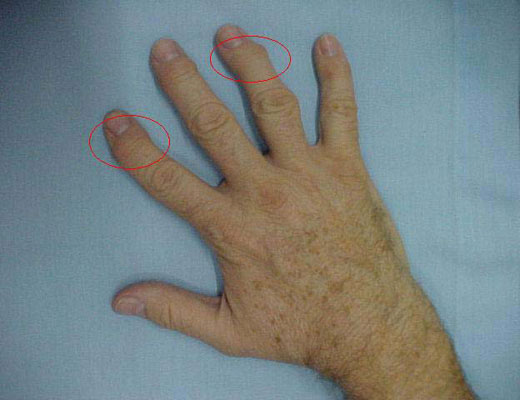 artrita nodulara tratamentul artrozei deformante a articulației umărului