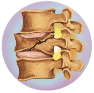 Resultado de imagem para fratura vÃ©rtebra
