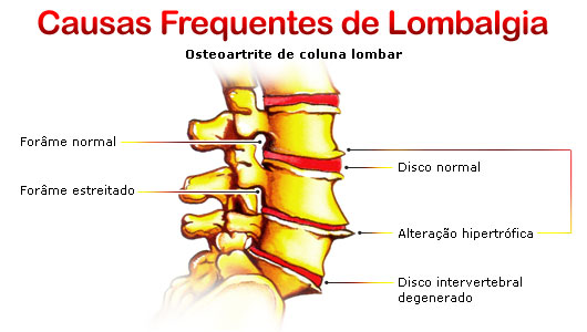 Lombalgia - Dicio, Dicionário Online de Português