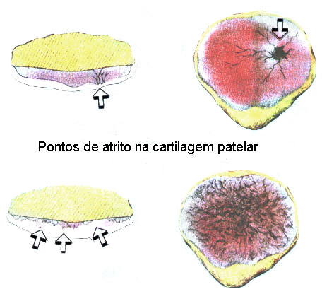 artroza deformantă a articulației patellofemorale)